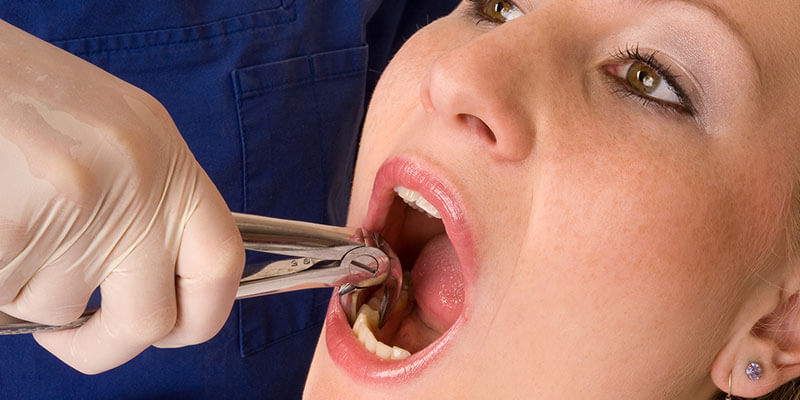 What are the Benefits of Root Canal Treatment ?