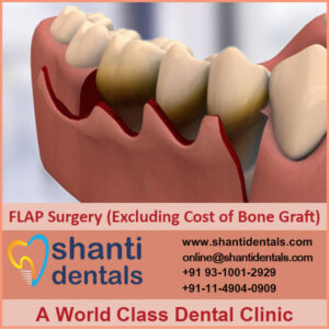 FLAP Surgery (Excluding Cost of Bone Graft)