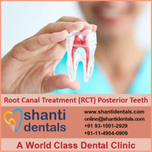 Root Canal Treatment (RCT) Posterior Teeth