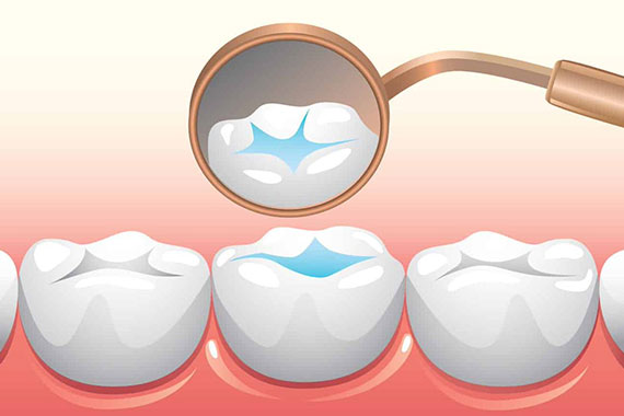 How Our Dental Sealant Treatments work