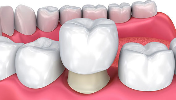 What should I expect after my child’s dental crown procedure?