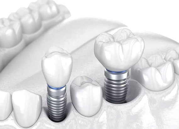 Conventional Implants