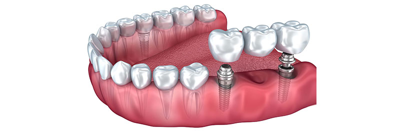 How does a single tooth implant work