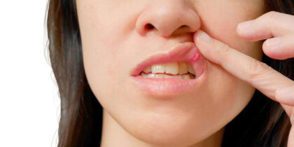 Mouth Ulcer Treatment Mouth Ulcer Treatment