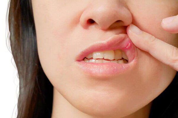 Mouth Ulcer Treatment