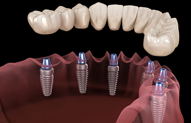 Placement of the six implants