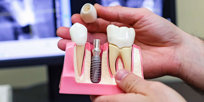 What is a single tooth dental implant?
