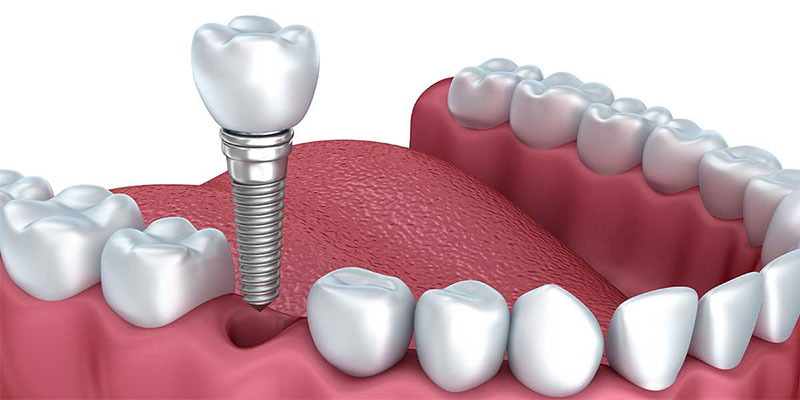 Why choose a single tooth dental implant