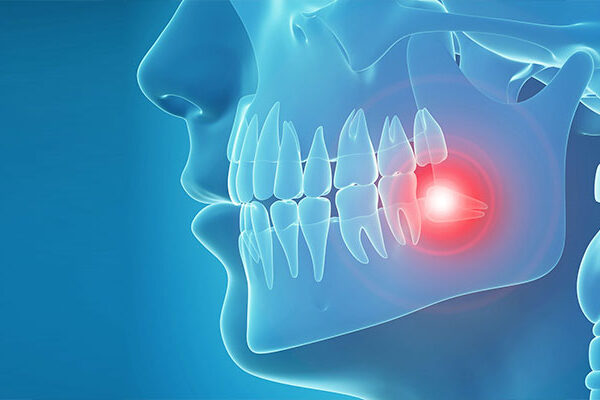 Wisdom Teeth Treatment