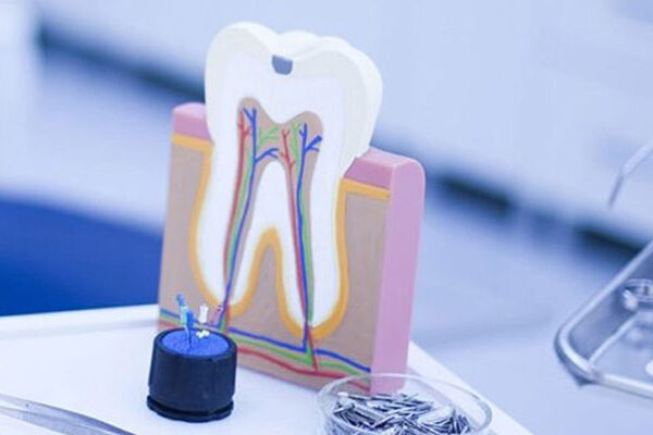 Painless Root Canal Treatment Single Sitting RCT