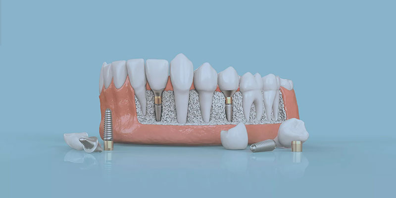 Enjoy natural looking smile With Dental Implant