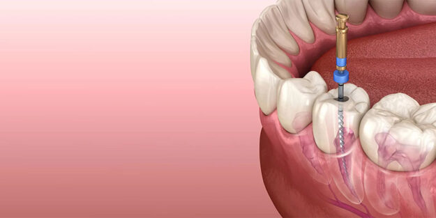 root-canal-treatment