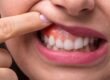 What is the Best solution for Pyria and Gum Diseases