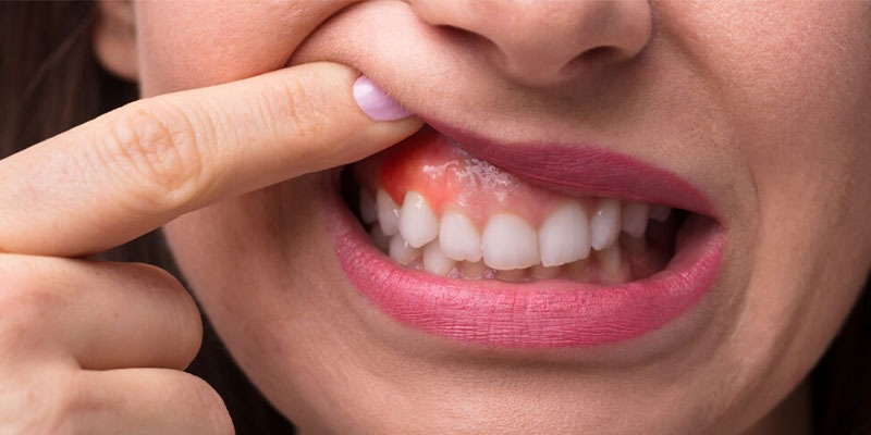 What is the Best solution for Pyria and Gum Diseases