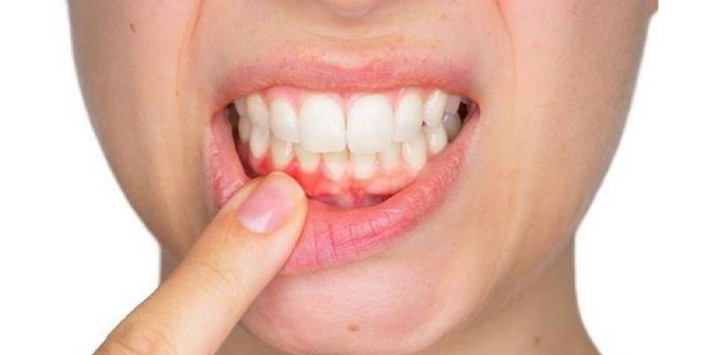 How to Remove Pyria from Teeth at Home