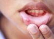7 home-remedies-for-mouth-ulcers-in-children