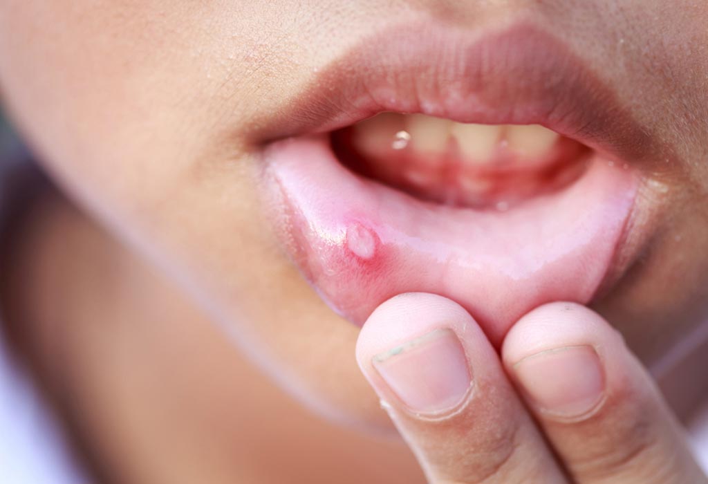 7 home-remedies-for-mouth-ulcers-in-children