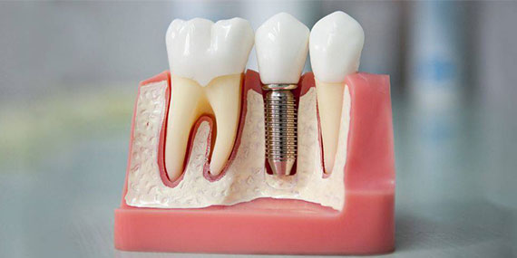 Single Tooth Dental Implant At Shanti Dentals, Rohini, Delhi